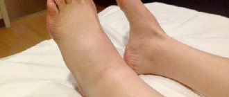 Swelling of the legs after a stroke