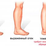 Отеки ног - Изображение 1 - Сеть клиник Семейный доктор