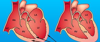 Причины возникновения кардиомиопатии
