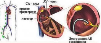 Cauterization of the heart