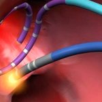 Radiofrequency ablation of the heart