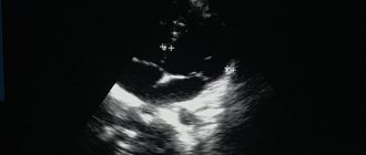 Interpretation of ultrasound of the heart
