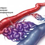 Расширение связей между артерией и веной приводит к развитию мальформации