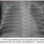 Рис. 1. Рентгенограмма органов грудной клетки (прямая проекция) на 80-е сут жизни. (Из архива Е.С. Трунцовой)