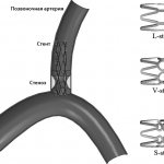 Схема стентирования позвоночной артерии