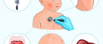 Symptoms of Epstein-Barr mononucleosis in children