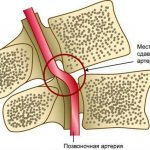 Синдром позвоночной артерии
