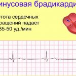 Sinus bradyarrhythmia in a child or teenager. What is it, playing sports 