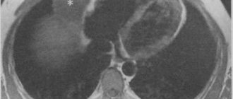 MRI and CT images. Pericardial cysts 