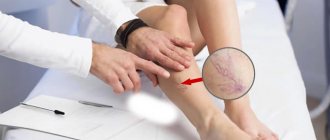 Spider veins on the legs - causes and treatment
