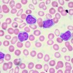 Stages of acute lymphoblastic leukemia