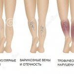 Stages of varicose veins or varicose veins of the lower extremities