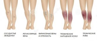 Stages of varicose veins or varicose veins of the lower extremities