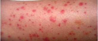rash due to vasculitis
