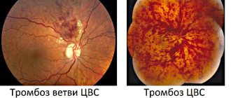 Thrombosis of the central retinal vein (CRV) and its branches