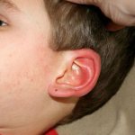 A child has an ear infection