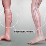 varicose veins - what is it?