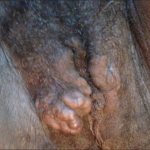 Varicose veins of the perineum and labia