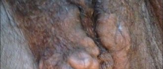 Varicose veins of the perineum and labia