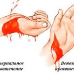 Types of bleeding