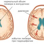Intracranial pressure is the force with which the brain presses on the walls of the skull