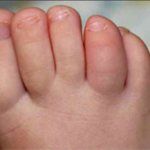 Inflammation of the toes