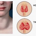 Inflammation of the thyroid gland