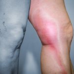 Inflammation of the veins in the legs